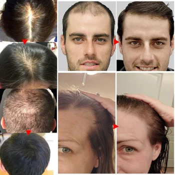 Джинджифил За Растежа На Косата Е Незаменим Продукт Срещу Косопад Серум За Бърз Растеж На Косата, Предпазва От Косопад Лечение На Кожата На Главата Подхранване За Мъже И Жени Изображение 2